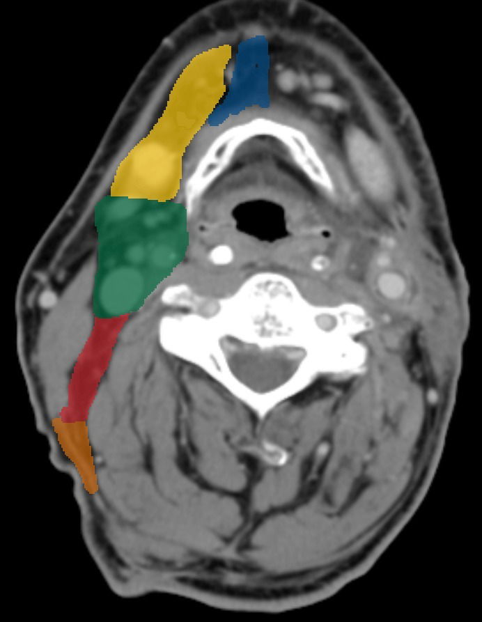 Lymph node regions in the neck