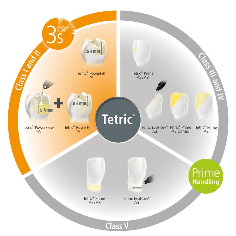 Klasse III og IV restaurert med Tetric Prime