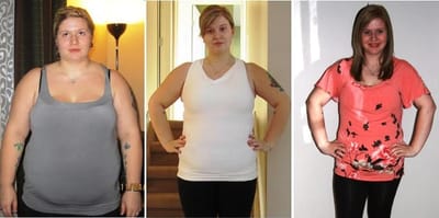 Know These Things if You Are Going to Have Lap Band Surgery