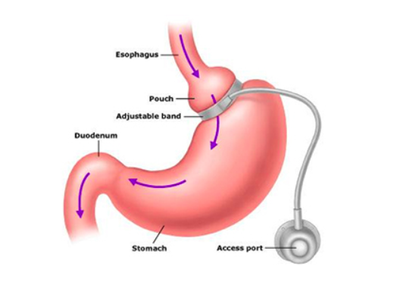 When a Doctor Can Suggest Lap Band Surgery?