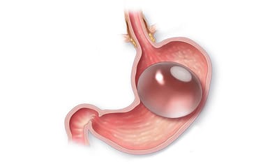 Considering a Gastric Balloon for Weight Loss? Here's What You Need to Know