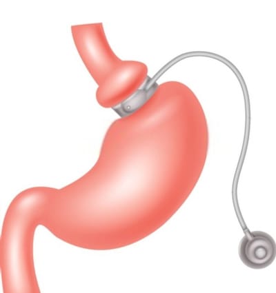 Why Gastric Banding is the Best Way to Lower Excess Body Weight?