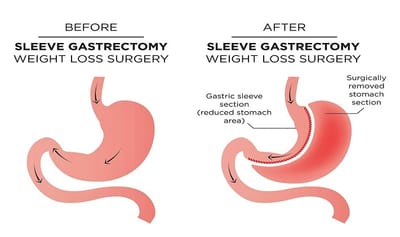 What To Expect After Gastric Sleeve Surgery ?