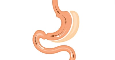 What To Look For In A Gastric Sleeve Surgeon?