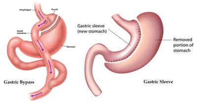 All You Need to Know About Gastric Banding and Orbera Balloon