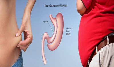 What Can You Expect After Weight Loss Surgery?