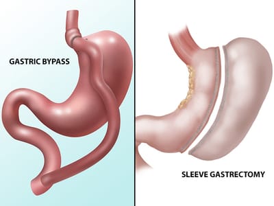 What Should You Prioritise When Selecting a Gastric Sleeve Surgeon?