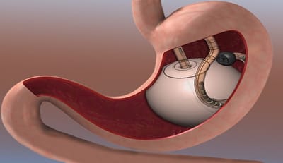 Gastric Sleeve Surgery Recovery: Tips for a Smooth Healing Process