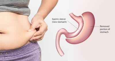 How to Identify a Trustworthy Gastric Sleeve Surgeon?