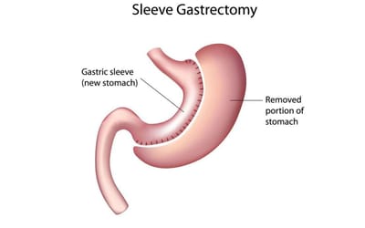 Empower Your Health: A Guide to Gastric Sleeve Surgery