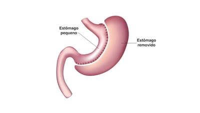 Why You Should Consult a Gastric Sleeve Surgeon for Weight Loss Surgery?