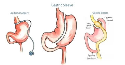 Long-Term Success: What Happens After Gastric Sleeve Surgery?