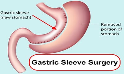 Essential Diet Tips for Post-Gastric Bypass Success