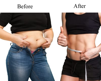 Finding Perfection: Selecting the Ideal Specialist for Gastric Sleeve Surgery