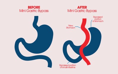 Recovery Timeline for Gastric Bypass Weight Loss Surgery Patients