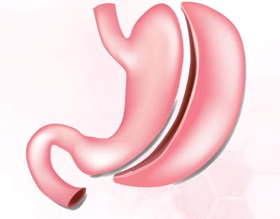5 Life-Changing Benefits of Gastric Sleeve Surgery You Must Know