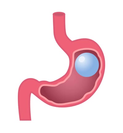 How Gastric Balloons Can Jumpstart Your Weight Loss Journey