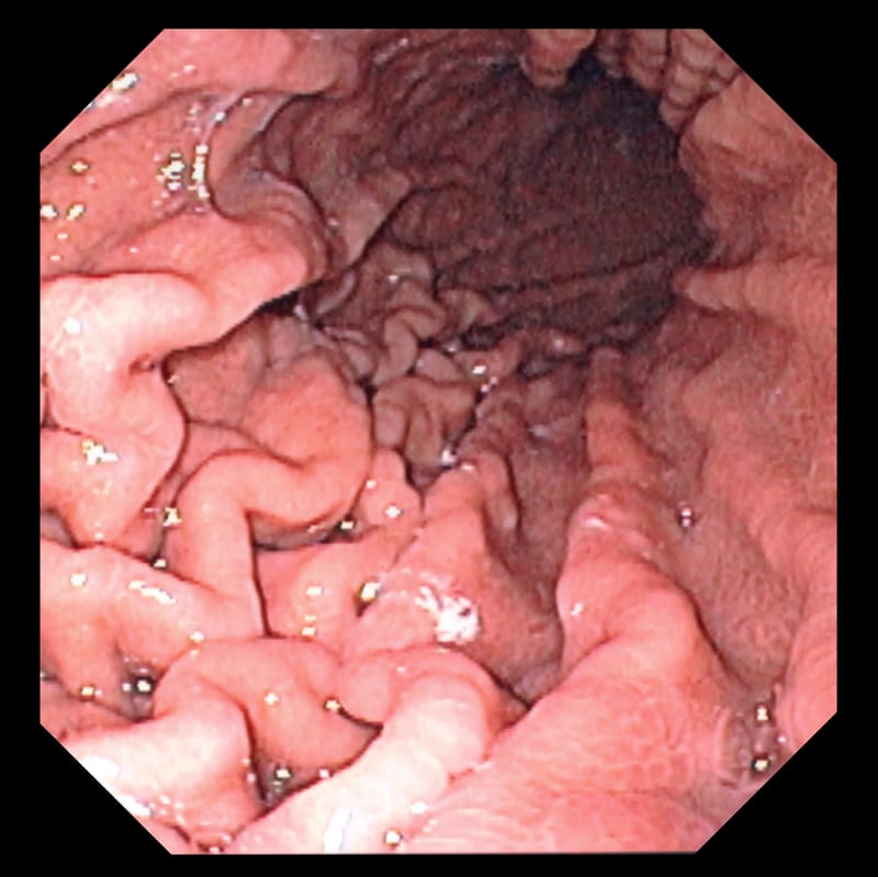 Endoscopia digestiva alta.