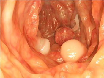 Colonoscopia