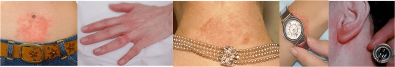 Protez Hastalarında Metal Alerjisi/Duyarlılığı?