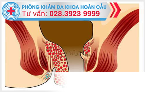 Nguyên nhân của bệnh trĩ nội độ 3