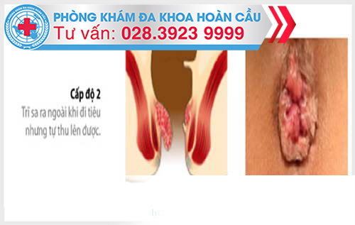 Nguyên nhân của bệnh trĩ nội độ 2