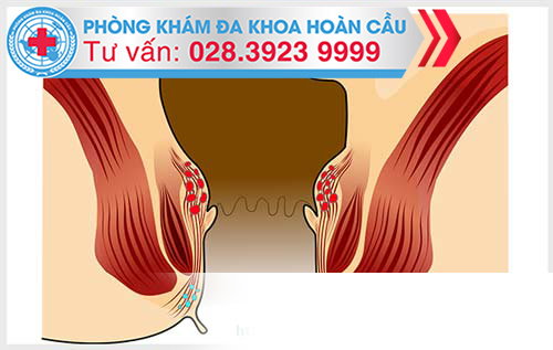 Nguyên nhân của trĩ nội độ 1