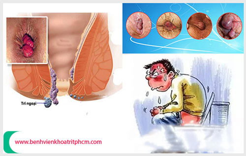 Nguyên nhân gây bệnh trĩ ngoại