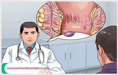 Cách chữa trị bệnh trĩ ngoại độ 2 hiệu quả nhất?