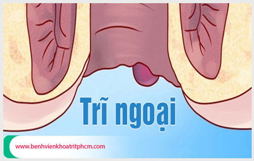 Cách điều trị trĩ ngoại độ 3 hiệu quả cao nhất