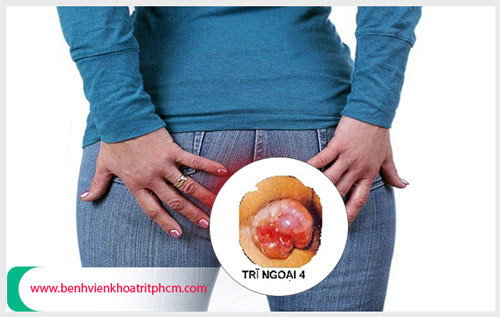 Bệnh trĩ ngoại độ 4 có biến chứng ung thư không?