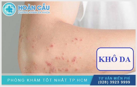 Chứng khô da có gây nổi mẩn ngứa đỏ?