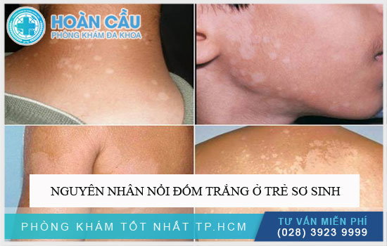 Thông tin y học về bệnh lang sửa ở trẻ nhỏ