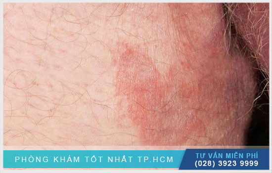 Điều trị nấm bẹn như thế nào?