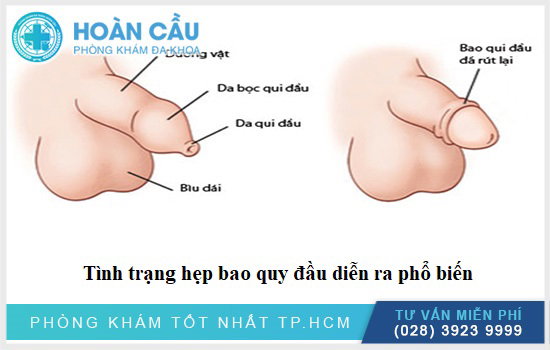 Tìm hiểu về vì sao bao quy đầu bị hẹp