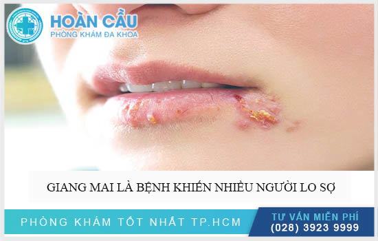 Đôi nét về bệnh Giang mai
