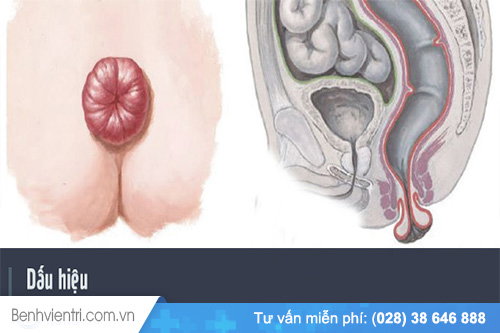 Bị trĩ là gì? Thế nào gọi là bị trĩ?