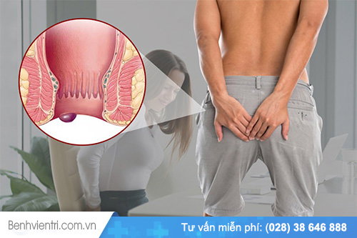 Cách làm giảm triệu chứng khi bị trĩ ngoại