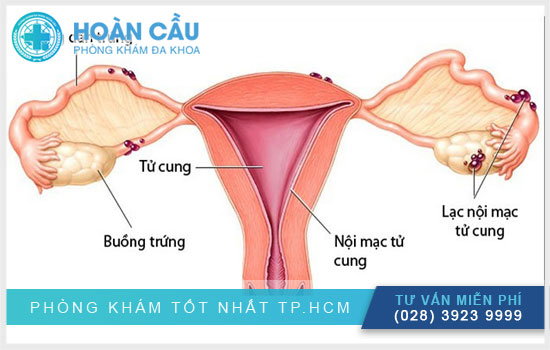 Viêm lạc nội mạc tử cung có thể mang thai không?