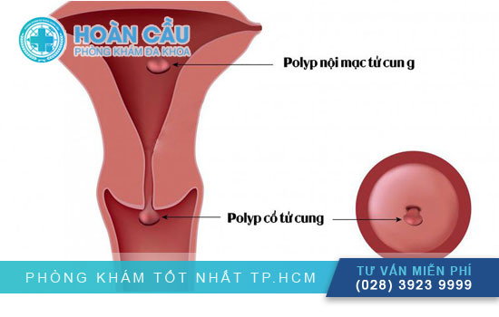 [Định nghĩa] Polyp cổ tử cung là gì?