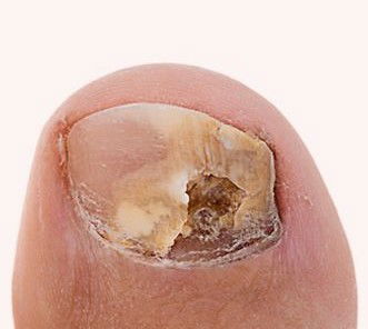 Fungal Nail Infections & Athlete's Foot