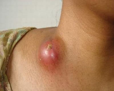 nổi hạch ở cổ có nguy hiểm không?