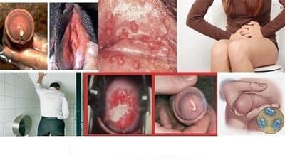 bệnh lậu có tự chữa khỏi ở nhà được không?