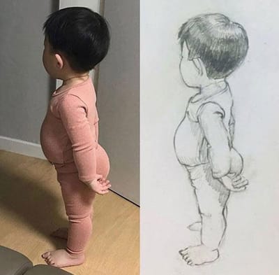 benh beo phi o tre em do nao