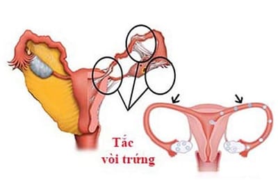 tac voi trung la gi chua o dau