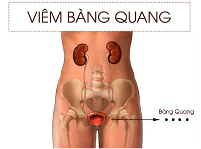 Viem bang quang cap co nguy hiem khong