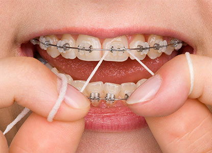 Evaluación de la higiene bucal en adolescentes con tratamiento de Ortodoncia