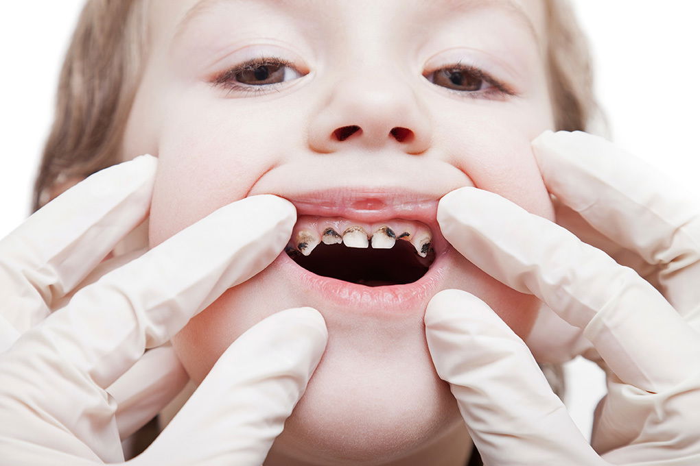 PROGRAMA EDUCATIVO ODONTOLÓGICO PARA LA PREVENCIÓN DE CARIES DENTAL EN INFANTES QUE ACUDEN AL CENTRO DE SALUD CRUZ DEL MÉDANO