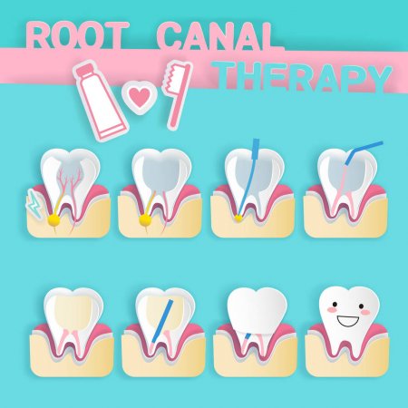 Root Canal Treatment