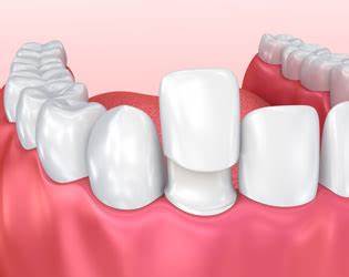 Re-cementation of a Crown, Veneer or Bridge